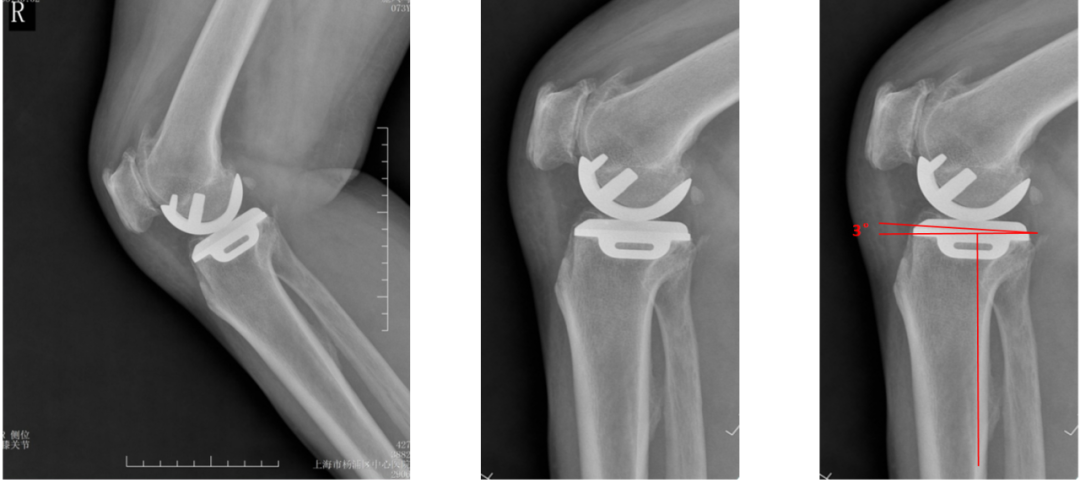 【读懂单髁】从读懂X-ray开始：胫骨假体位置解读