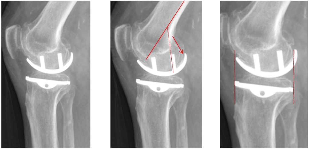 【读懂单髁】从读懂X-ray开始：固定平台单髁假体(LINK®