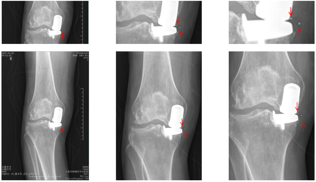 【读懂单髁】从读懂X-ray开始：术后摄片技术及垫片位置解读