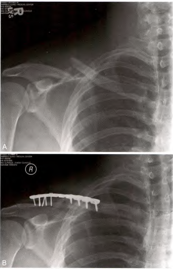 锁骨骨折：从分型到治疗的超全讲解，一文搞定！
