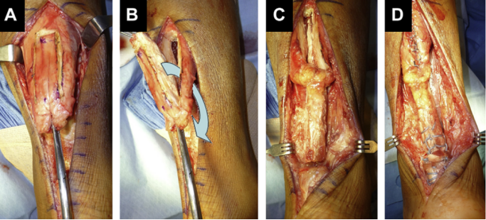 ​图文并茂：慢性跟腱断裂的最新治疗进展