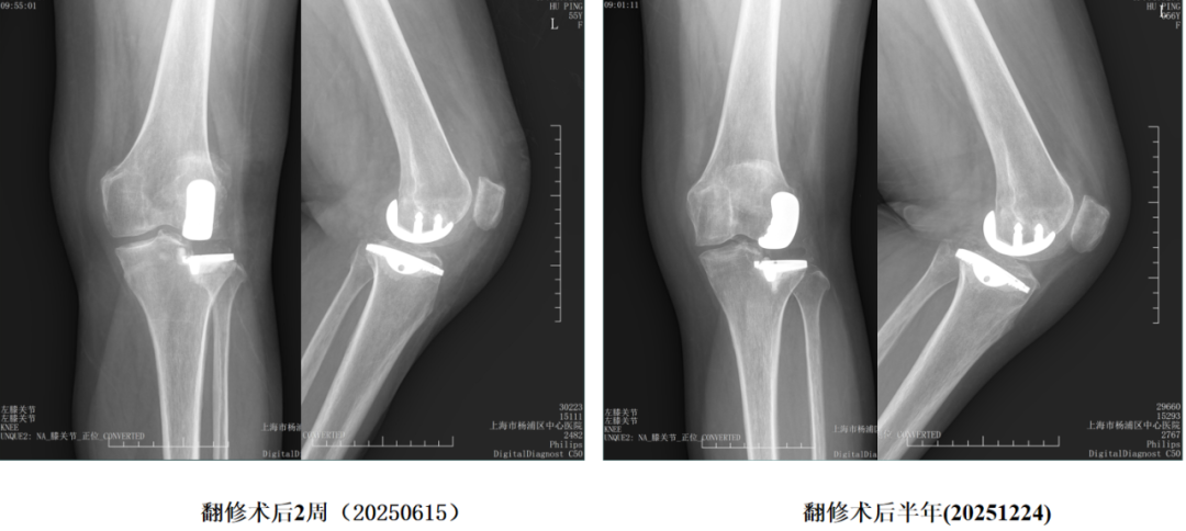 【读懂单髁】从读懂X-ray开始：固定平台单髁假体(SIGMA®