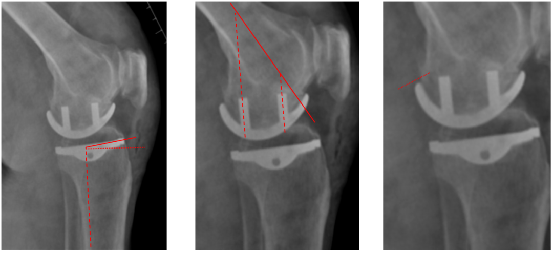 【读懂单髁】从读懂X-ray开始：固定平台单髁假体(LINK®