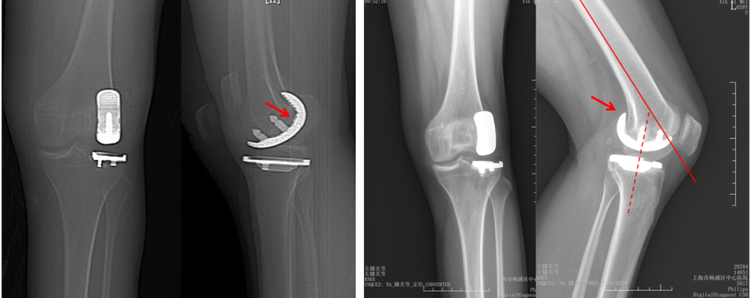 【读懂单髁】从读懂X-ray开始：固定平台单髁假体(SIGMA®