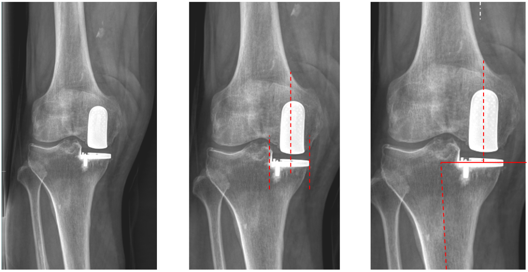 【读懂单髁】从读懂X-ray开始：固定平台单髁假体(LINK®