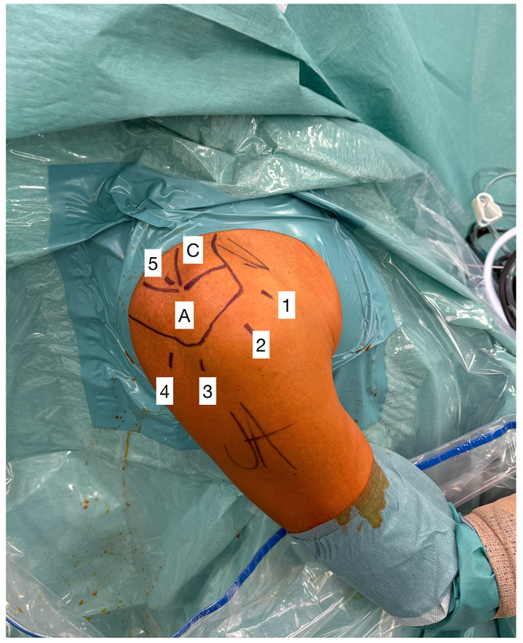 Hosentraeger技术：使用肱二头肌长头腱的关节镜下腱-腱置入术治疗不可修复肩袖撕裂