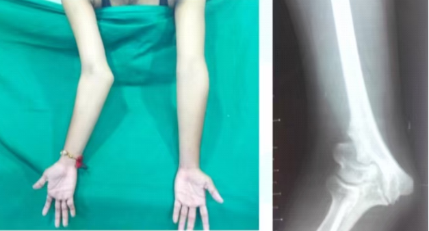 儿童肱骨外髁骨折的诊疗，本文全面总结！