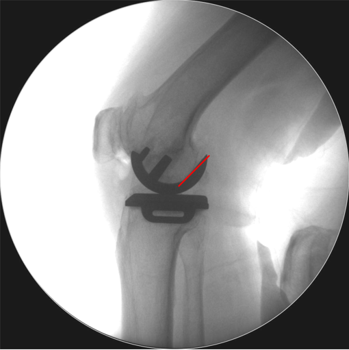 【读懂单髁】从读懂X-ray开始：术后摄片技术及垫片位置解读
