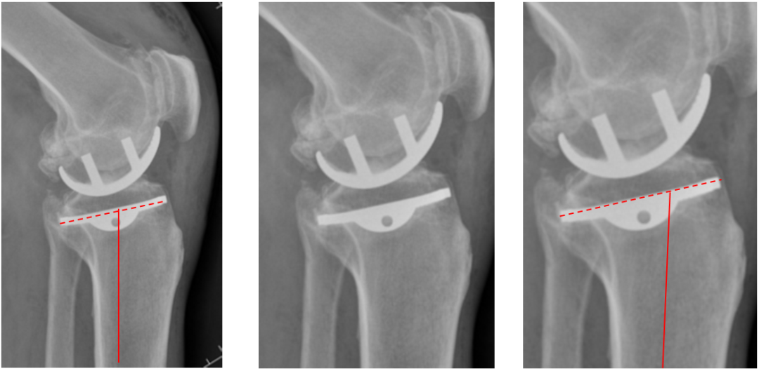 【读懂单髁】从读懂X-ray开始：固定平台单髁假体(LINK®