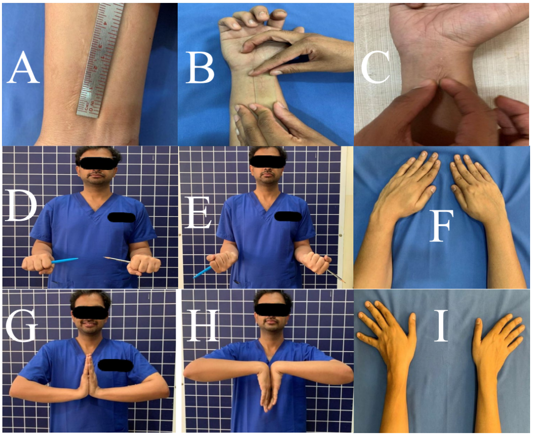 一文掌握，桡骨远端骨折微创钢板接骨术（MIPO），功能与美学效果双达标的安全技术！