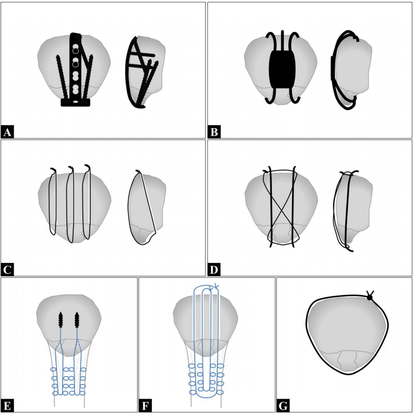 髌骨下极骨折的手术治疗技巧，你都掌握了吗？