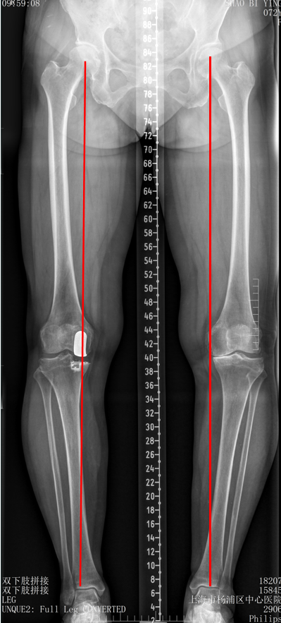 【读懂单髁】从读懂X-ray开始：固定平台单髁假体(LINK®
