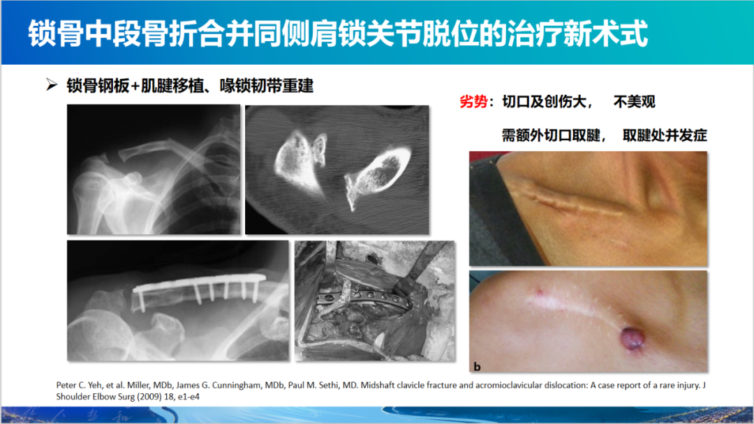 锁骨中段骨折合并同侧肩锁关节脱位新术式：弹性髓内钉+喙锁韧带重建、关节囊缝合