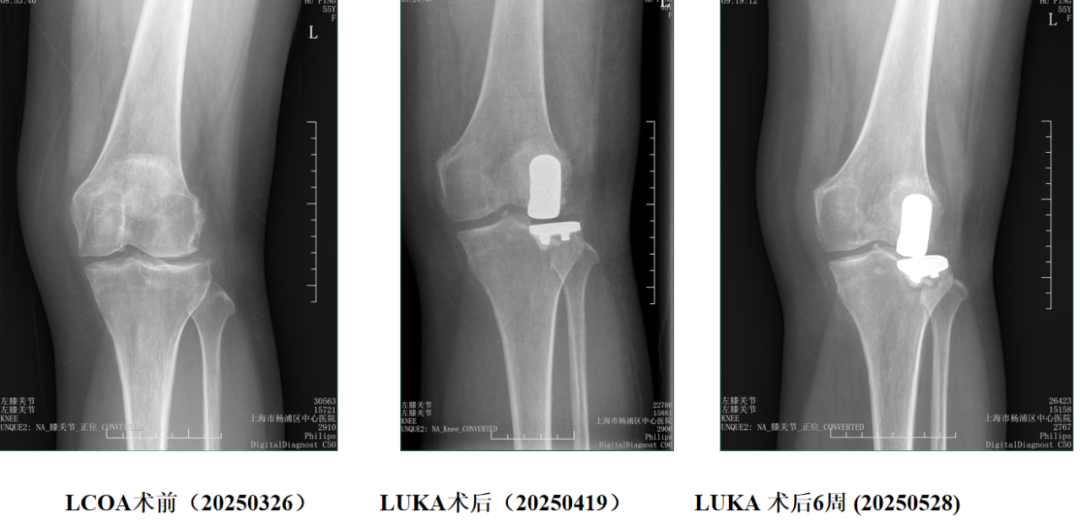 【读懂单髁】从读懂X-ray开始：固定平台单髁假体(SIGMA®