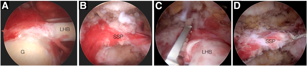 Hosentraeger技术：使用肱二头肌长头腱的关节镜下腱-腱置入术治疗不可修复肩袖撕裂