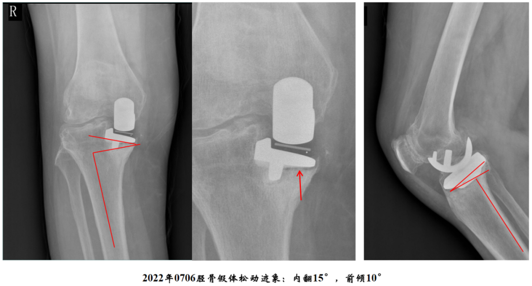 【读懂单髁】从读懂X-ray开始：胫骨假体位置解读
