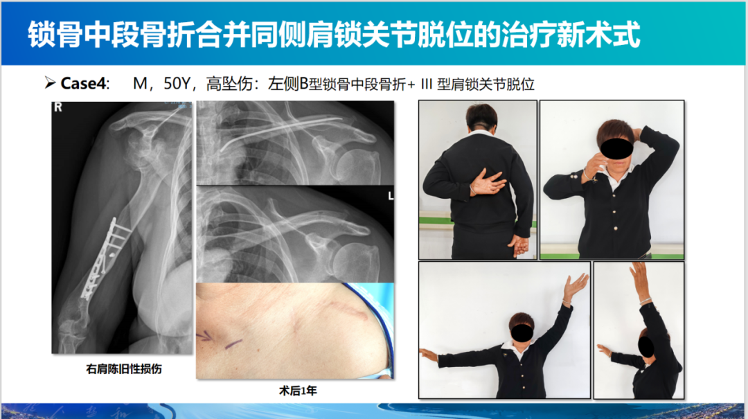 锁骨中段骨折合并同侧肩锁关节脱位新术式：弹性髓内钉+喙锁韧带重建、关节囊缝合