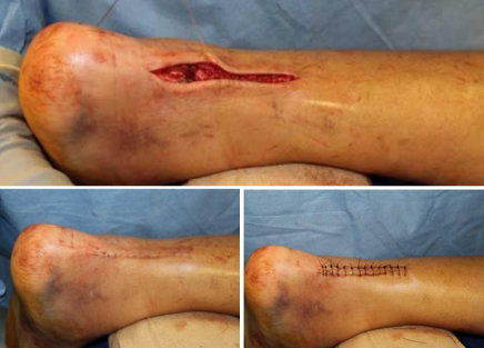 【手术技术】切开修复技术治疗急性跟腱断裂