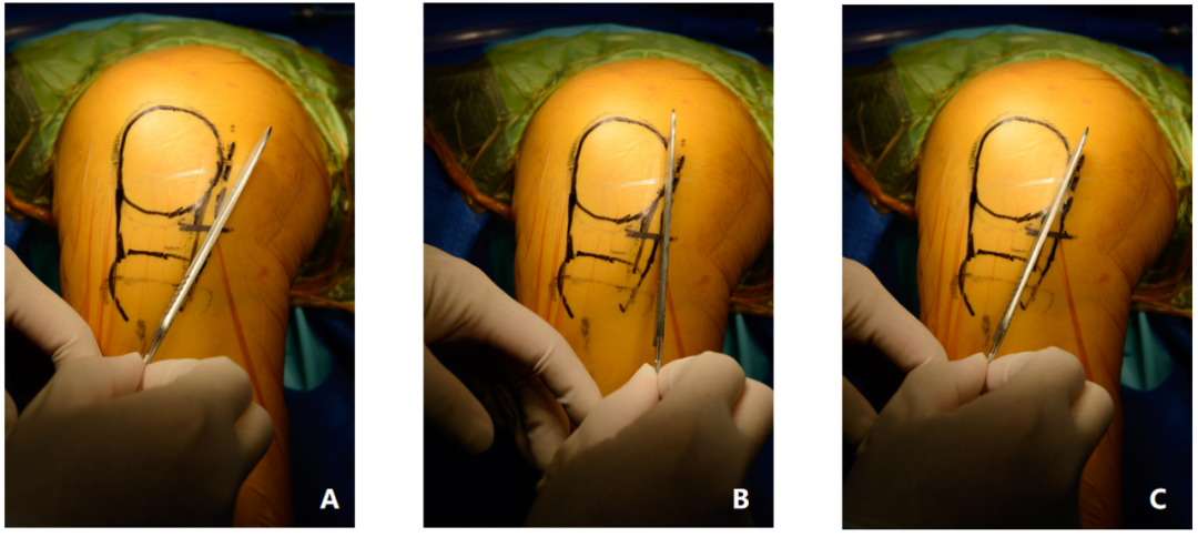 【滑动垫片单髁置换技术精讲系列】第一讲：麻醉、体位