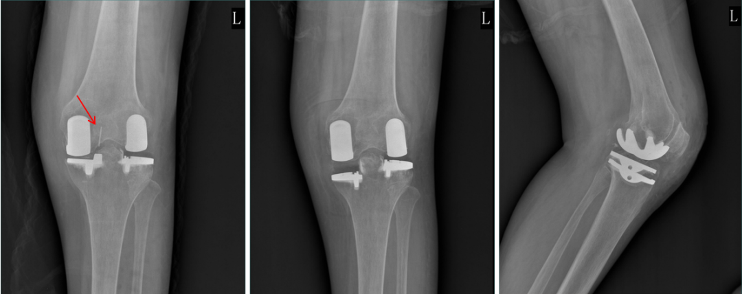 【读懂单髁】从读懂X-ray开始：固定平台单髁假体(LINK®