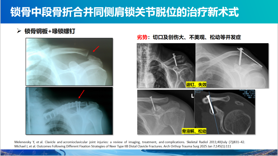 锁骨中段骨折合并同侧肩锁关节脱位新术式：弹性髓内钉+喙锁韧带重建、关节囊缝合