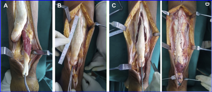 ​图文并茂：慢性跟腱断裂的最新治疗进展