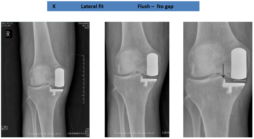 【读懂单髁】从读懂X-ray开始：胫骨假体位置解读