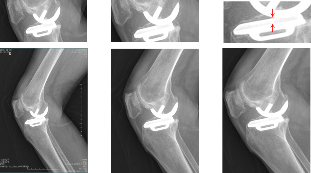 【读懂单髁】从读懂X-ray开始：术后摄片技术及垫片位置解读