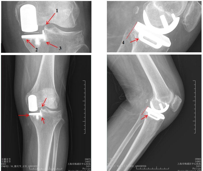 【读懂单髁】从读懂X-ray开始：胫骨假体位置解读