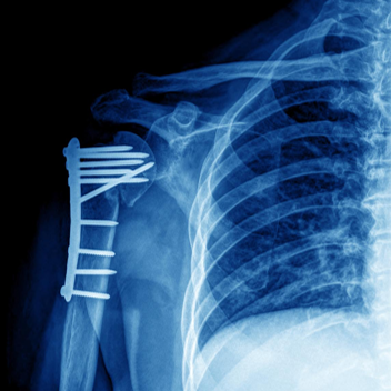 锁骨骨折：从分型到治疗的超全讲解，一文搞定！