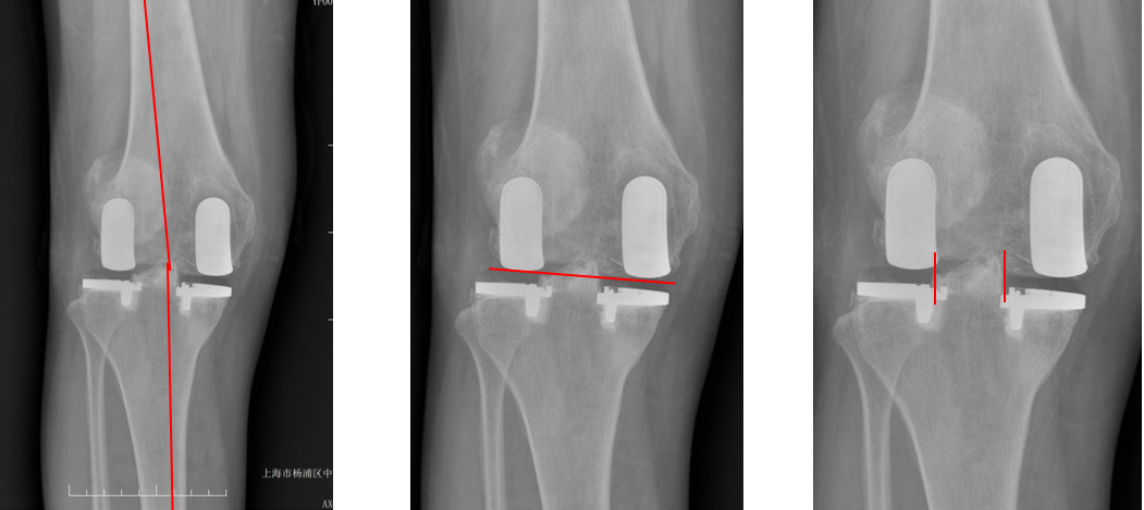 【读懂单髁】从读懂X-ray开始：固定平台单髁假体(LINK®