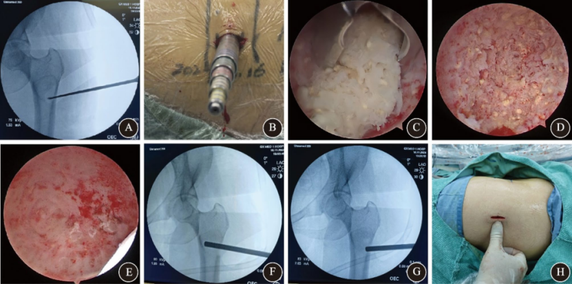 关节镜辅助单孔非同轴内镜手术治疗的前世今生