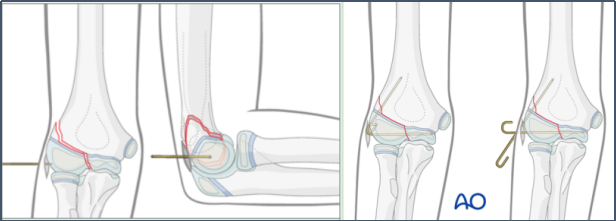 儿童肱骨外髁骨折的诊疗，本文全面总结！