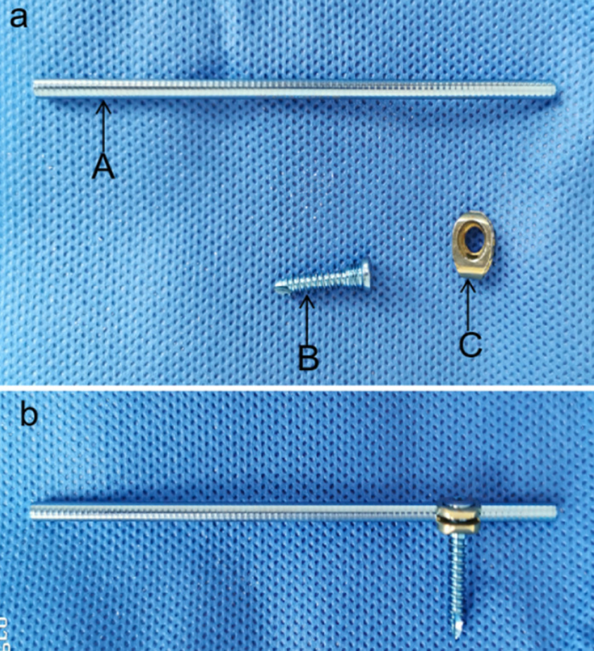 锁骨骨折：从分型到治疗的超全讲解，一文搞定！