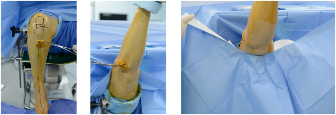 【滑动垫片单髁置换技术精讲系列】第一讲：麻醉、体位