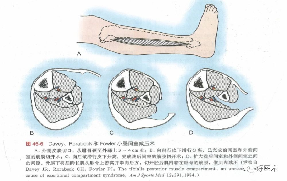 ​何时清创？如何减少感染？关于开放性骨折，你需要知道的方方面面！
