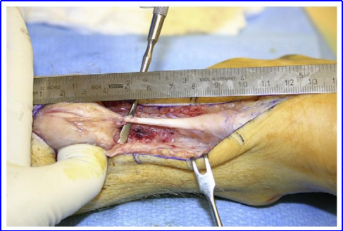 ​图文并茂：慢性跟腱断裂的最新治疗进展