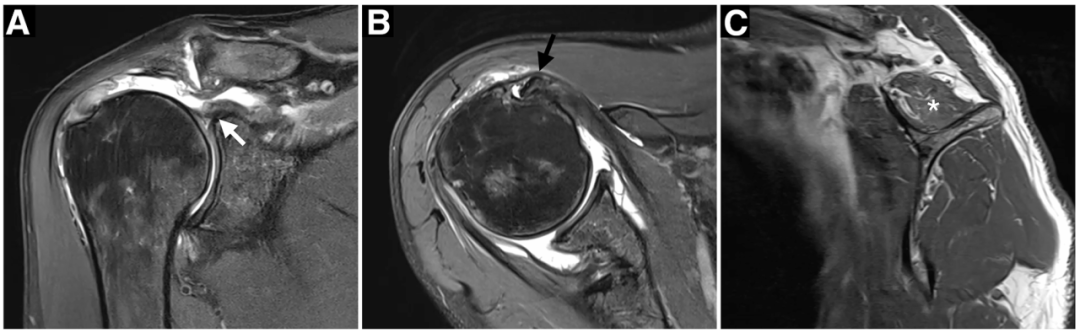 Hosentraeger技术：使用肱二头肌长头腱的关节镜下腱-腱置入术治疗不可修复肩袖撕裂