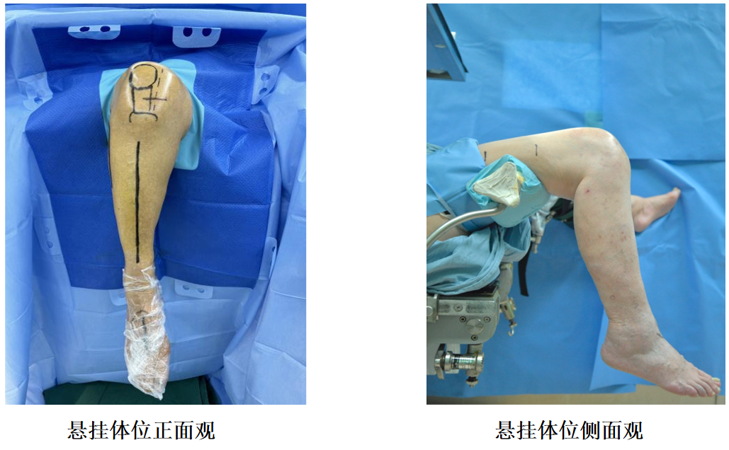 【滑动垫片单髁置换技术精讲系列】第一讲：麻醉、体位