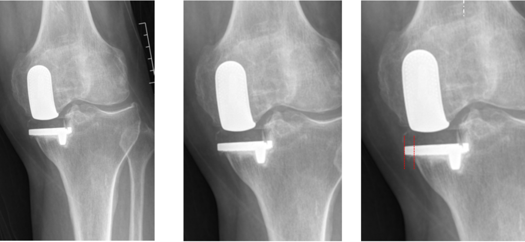 【读懂单髁】从读懂X-ray开始：固定平台单髁假体(LINK®