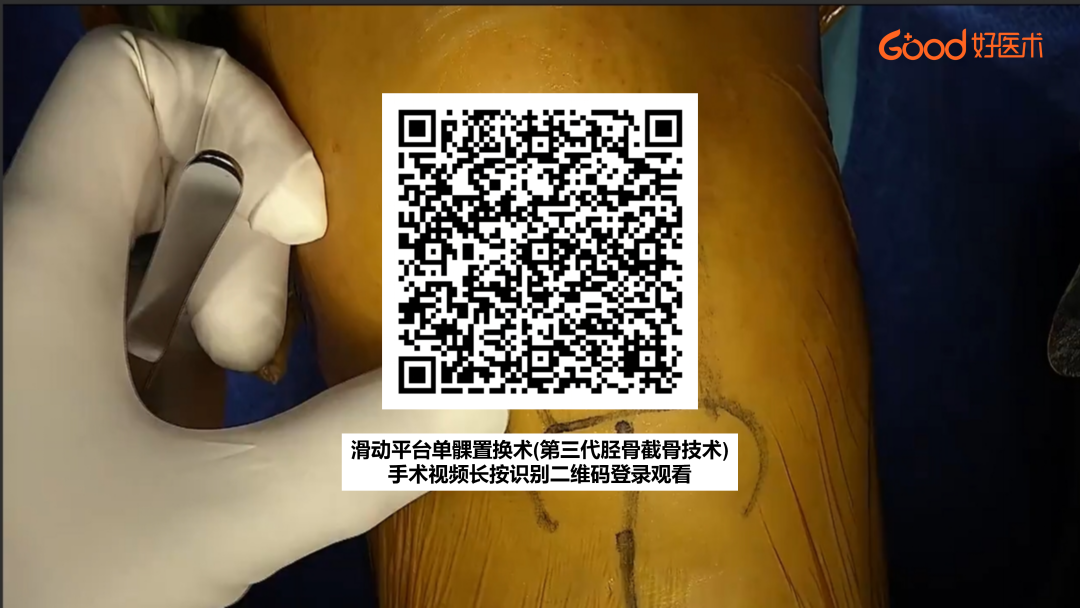 【手术视频】第三期：滑动平台单髁置换术(第三代胫骨截骨技术)