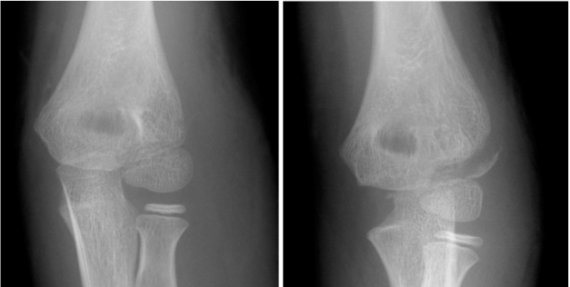 儿童肱骨外髁骨折的诊疗，本文全面总结！