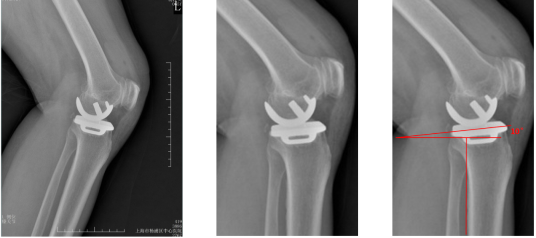 【读懂单髁】从读懂X-ray开始：胫骨假体位置解读