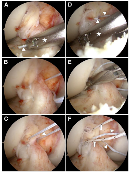 图文详解关节镜下如何实现对前交叉韧带近端撕裂的精准修复