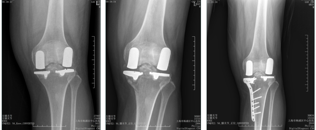 【读懂单髁】从读懂X-ray开始：固定平台单髁假体(LINK®