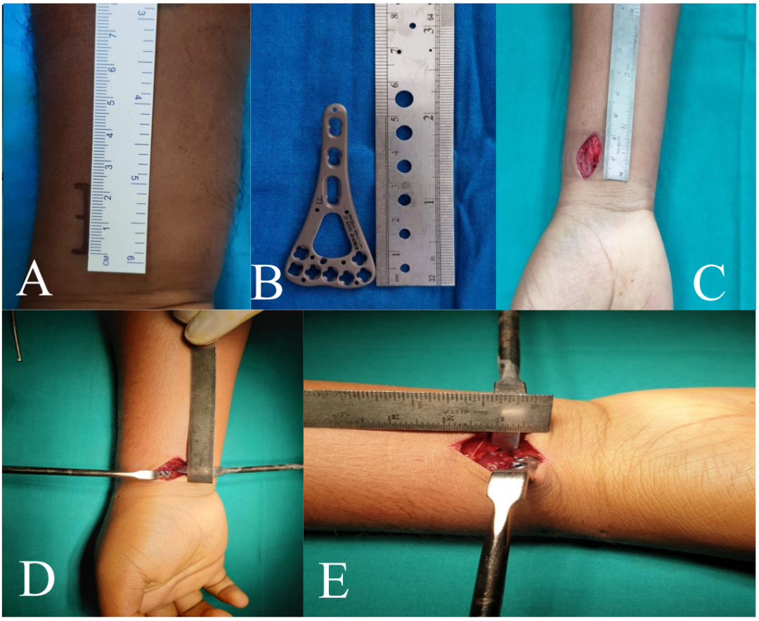 一文掌握，桡骨远端骨折微创钢板接骨术（MIPO），功能与美学效果双达标的安全技术！