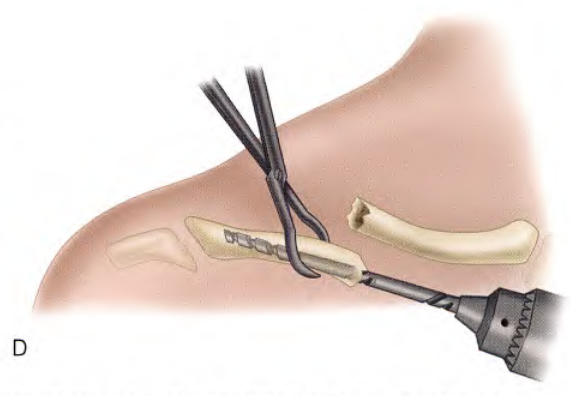 锁骨骨折：从分型到治疗的超全讲解，一文搞定！