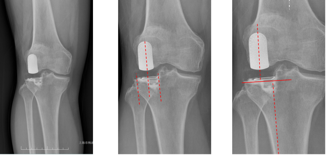 【读懂单髁】从读懂X-ray开始：固定平台单髁假体(LINK®