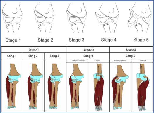 儿童肱骨外髁骨折的诊疗，本文全面总结！