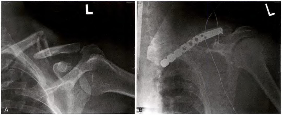 锁骨骨折：从分型到治疗的超全讲解，一文搞定！